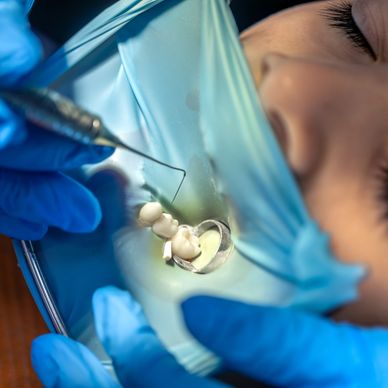 Dentist placing a protective dental crown during tooth cap treatment for kids.
