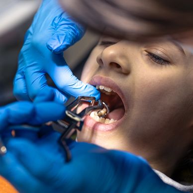 A dentist performs a tooth extraction for a child using specialized dental tools.
