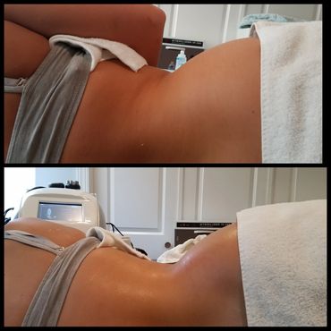 body sculpting, masages reductores en new jersey, cryoskin , coolsculpting, reduce fat, tone skin