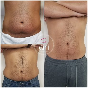 body sculpting, masages reductores en new jersey, cryoskin , coolsculpting, reduce fat, tone skin