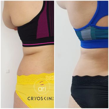 body sculpting, masages reductores en new jersey, cryoskin , coolsculpting, reduce fat, tone skin