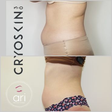 body sculpting, masages reductores en new jersey, cryoskin , coolsculpting, reduce fat, tone skin