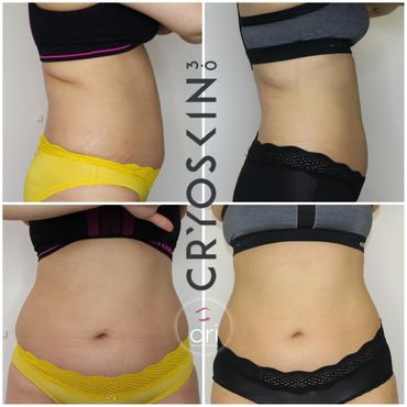 body sculpting, masages reductores en new jersey, cryoskin , coolsculpting, reduce fat, tone skin