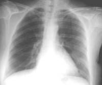 Chest Xray