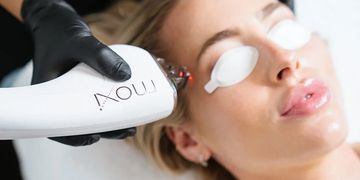 Moxi laser
hyperpigmentation removal
freckle removal
sun spots
laser facial