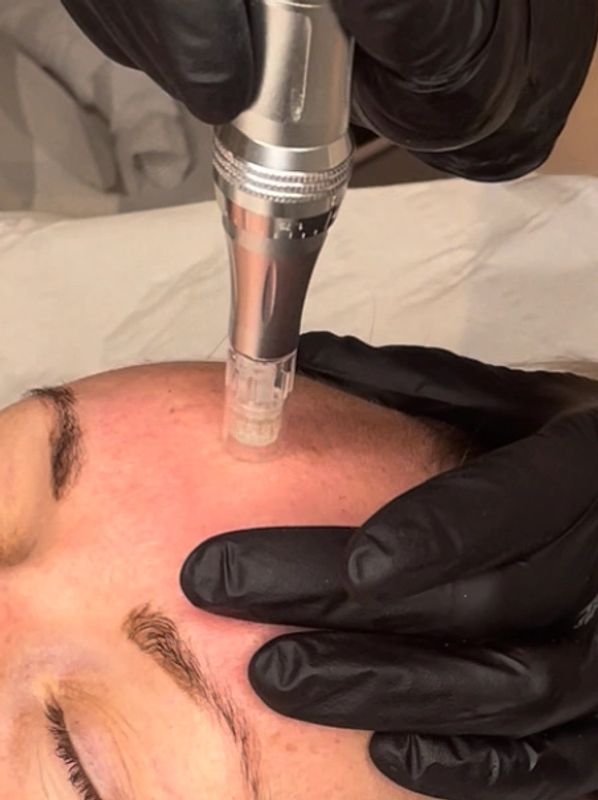 Woman having a microneedling (collagen induction therapy) treatment carried out