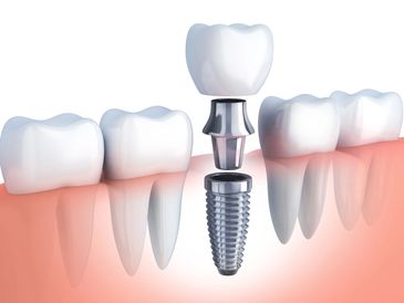 Implant, Teeth, Replace Missing Teeth, Serenity Cosmetic Dental