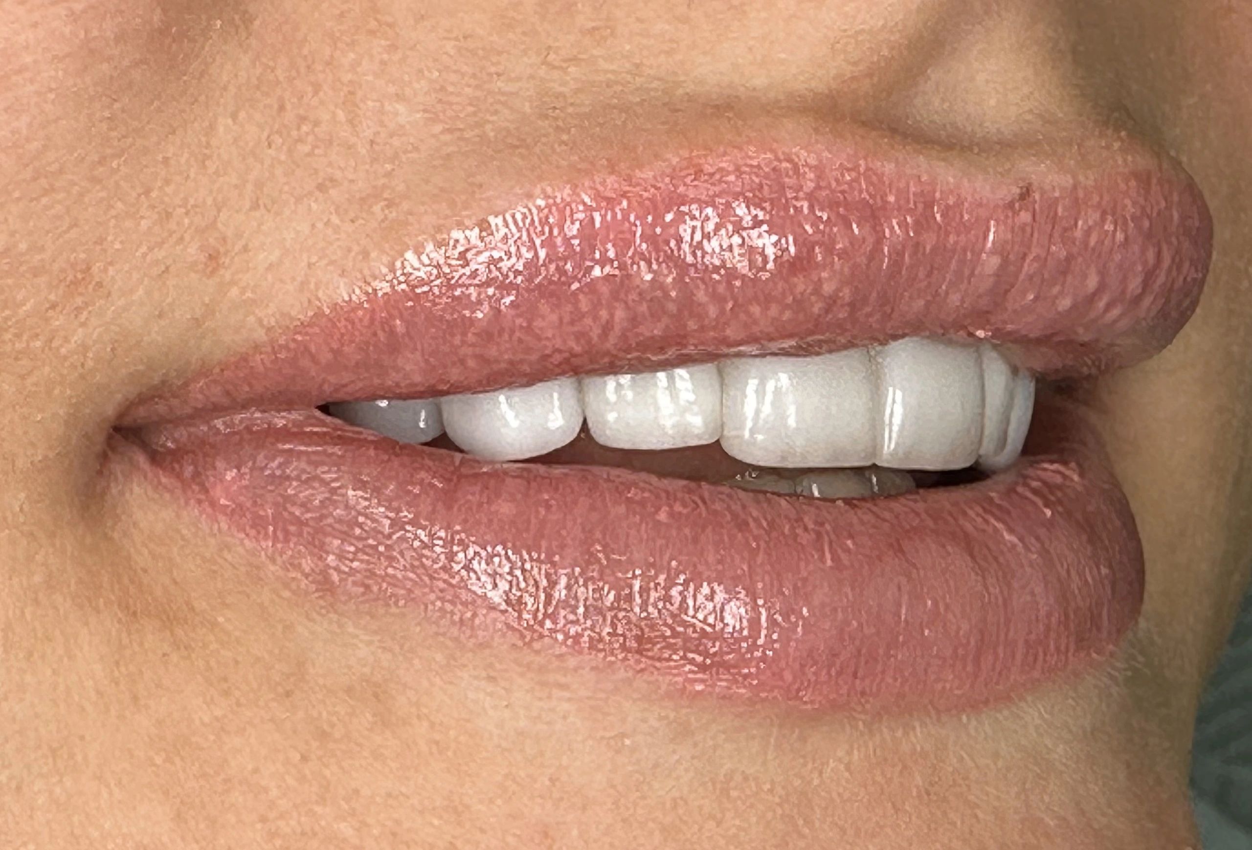 2 ml lips