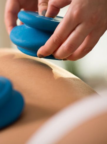 Cupping on the back - FMT Stretching and Massage Therapy