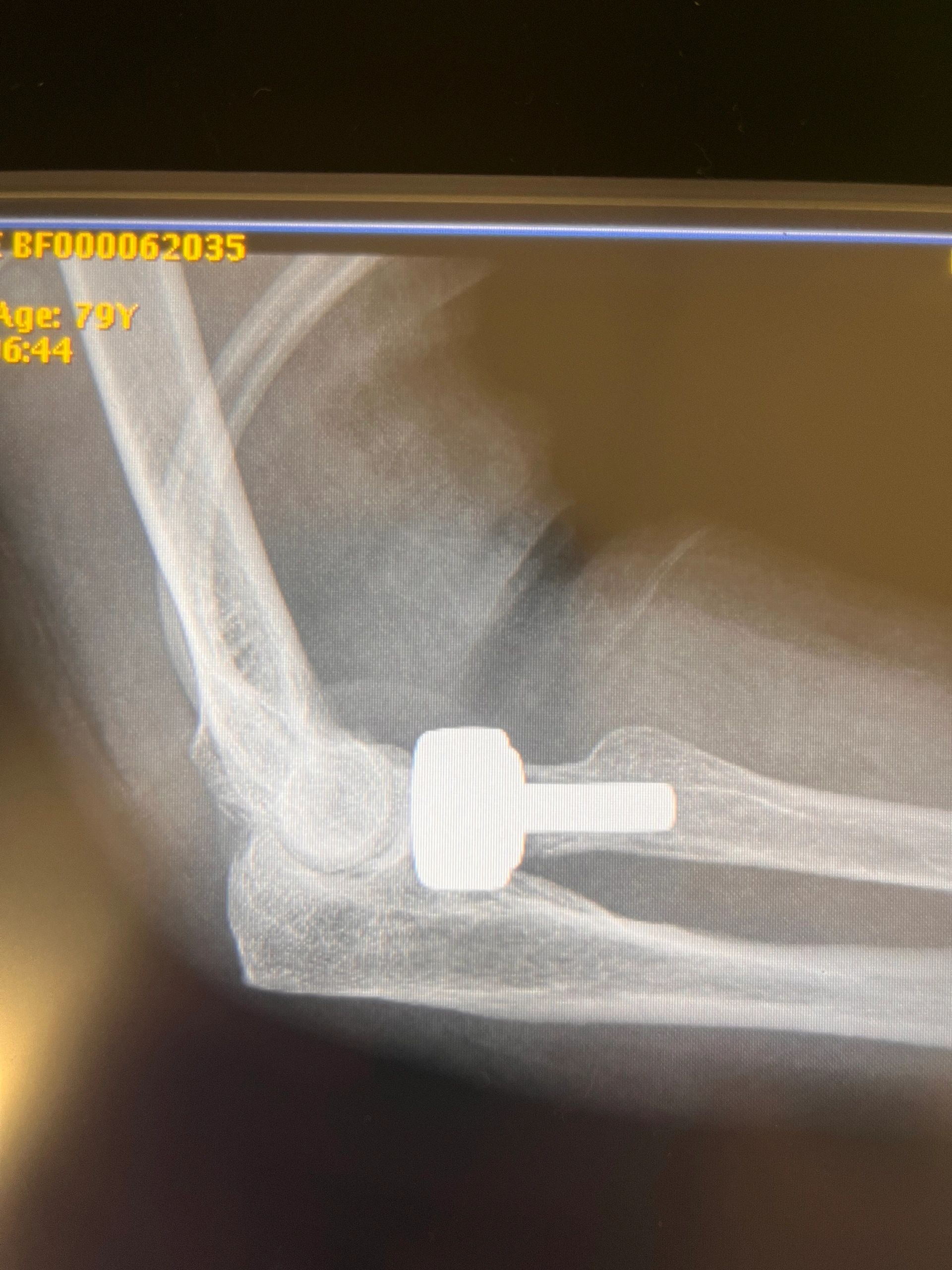 Top Tier Orthopedics & Center for Joint Replacement Co.