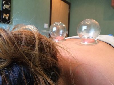 Glass fire cupping on back