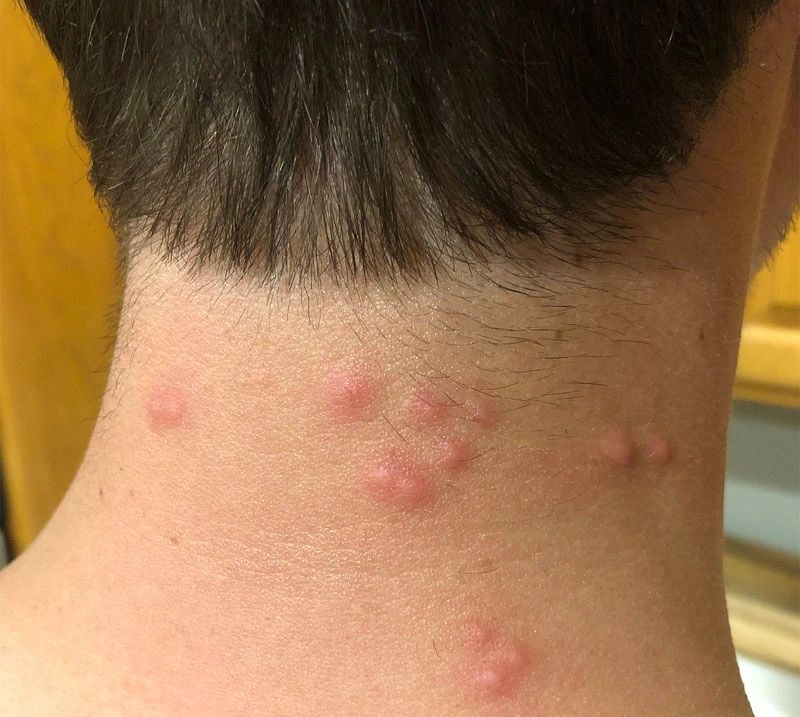 bed bug bites on babies neck