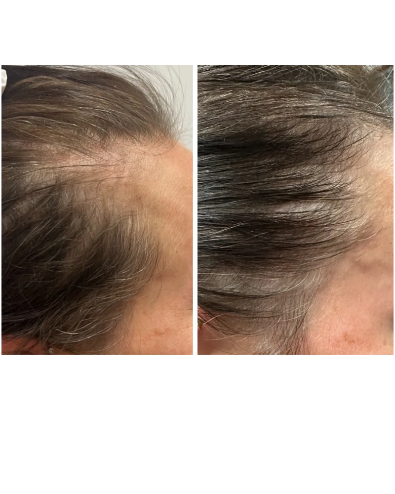 Before and after comparison of hair regrowth on a scalp.
