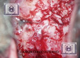 cáncer cervical, cáncer del cuello uterino, cáncer cervicouterino