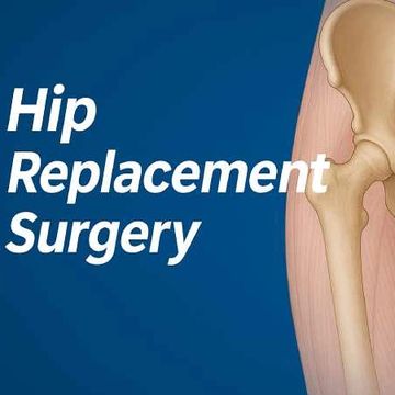 Cost efficient  hip replacement surgery