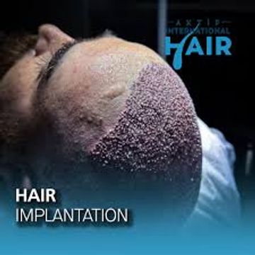 Cost efficient hair transplant