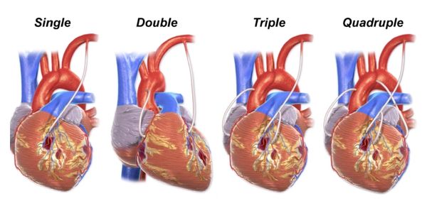 Coronary bypass surgery