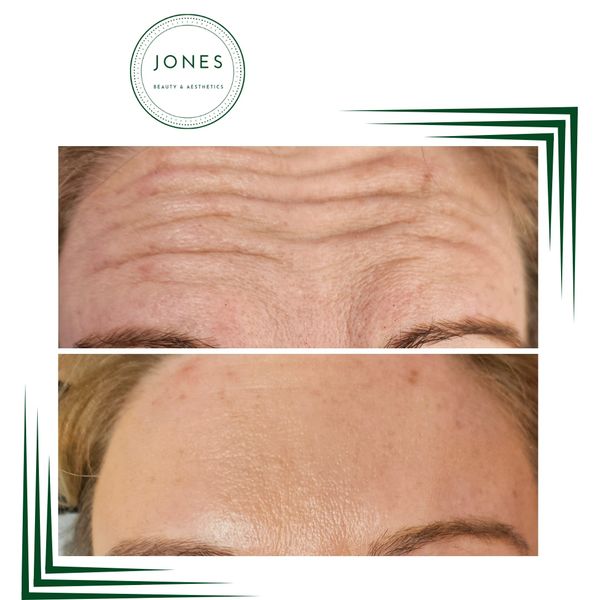 anti-wrinkle injection botox toxin frown lines glabellar forehead lines anti ageing 