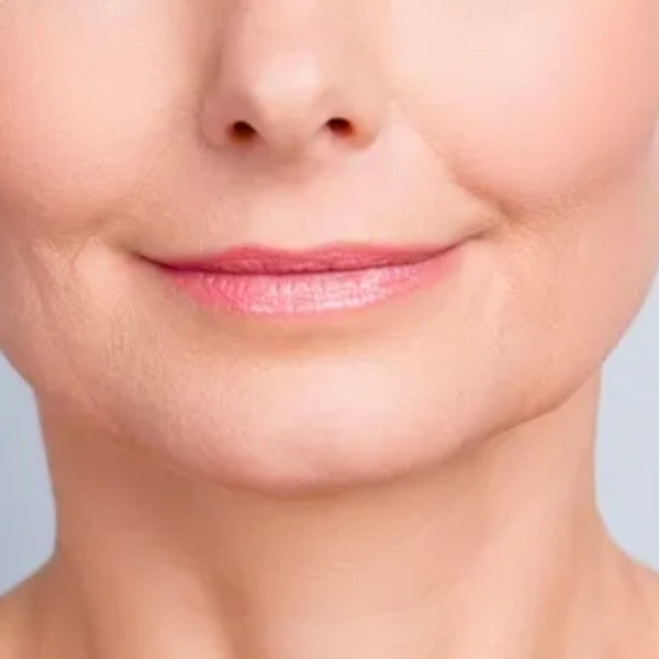 marionette filler nasolabial fold filler dermal filler