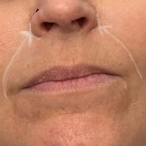 nasolabial fold filler dermal filler