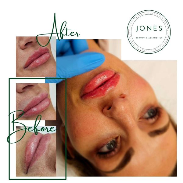 lip augmentation lip filler dermal filler natural lips