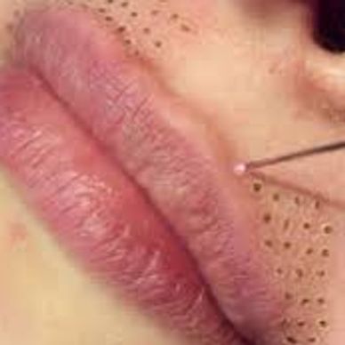 Sesión de fobroblast - plasmapen en código de barras, labio superior