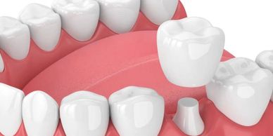 Tooth restoration with prosthetics.