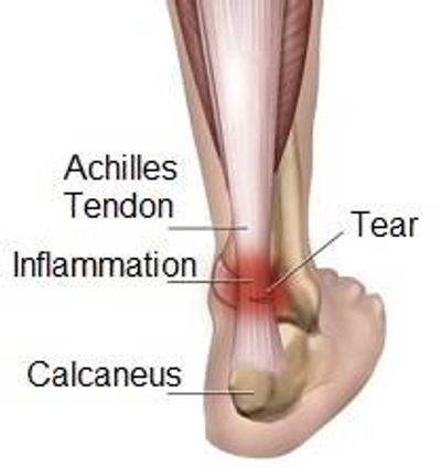 Achilles Tendonitis