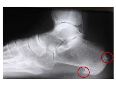 X-Ray image of heel spurs
