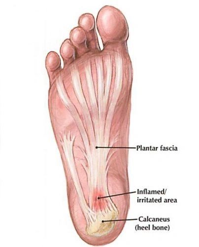 Plantar Fasciitis – Frequently Asked Questions