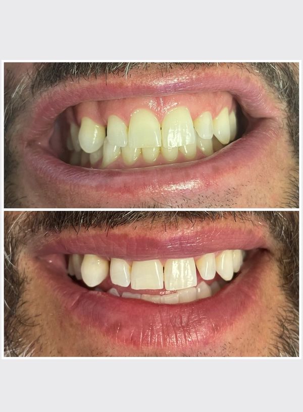 Before and after of teeth whitening