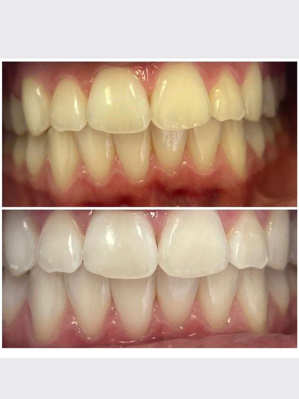 Before and after of teeth whitening