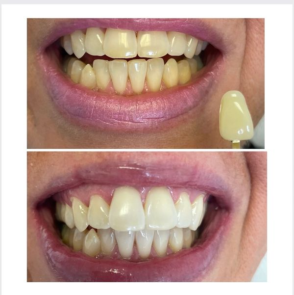 Before and after of teeth whitening