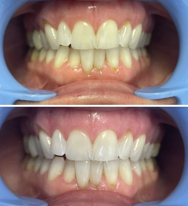 Before and after of teeth whitening