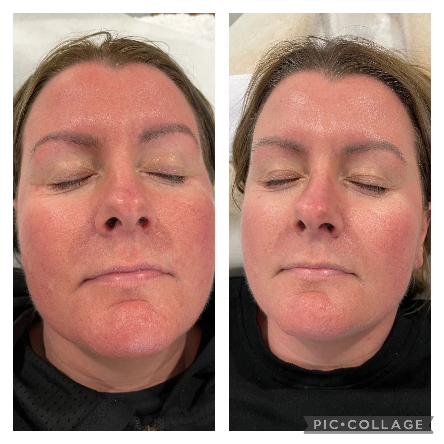 Microneedling Results after 3 treatments