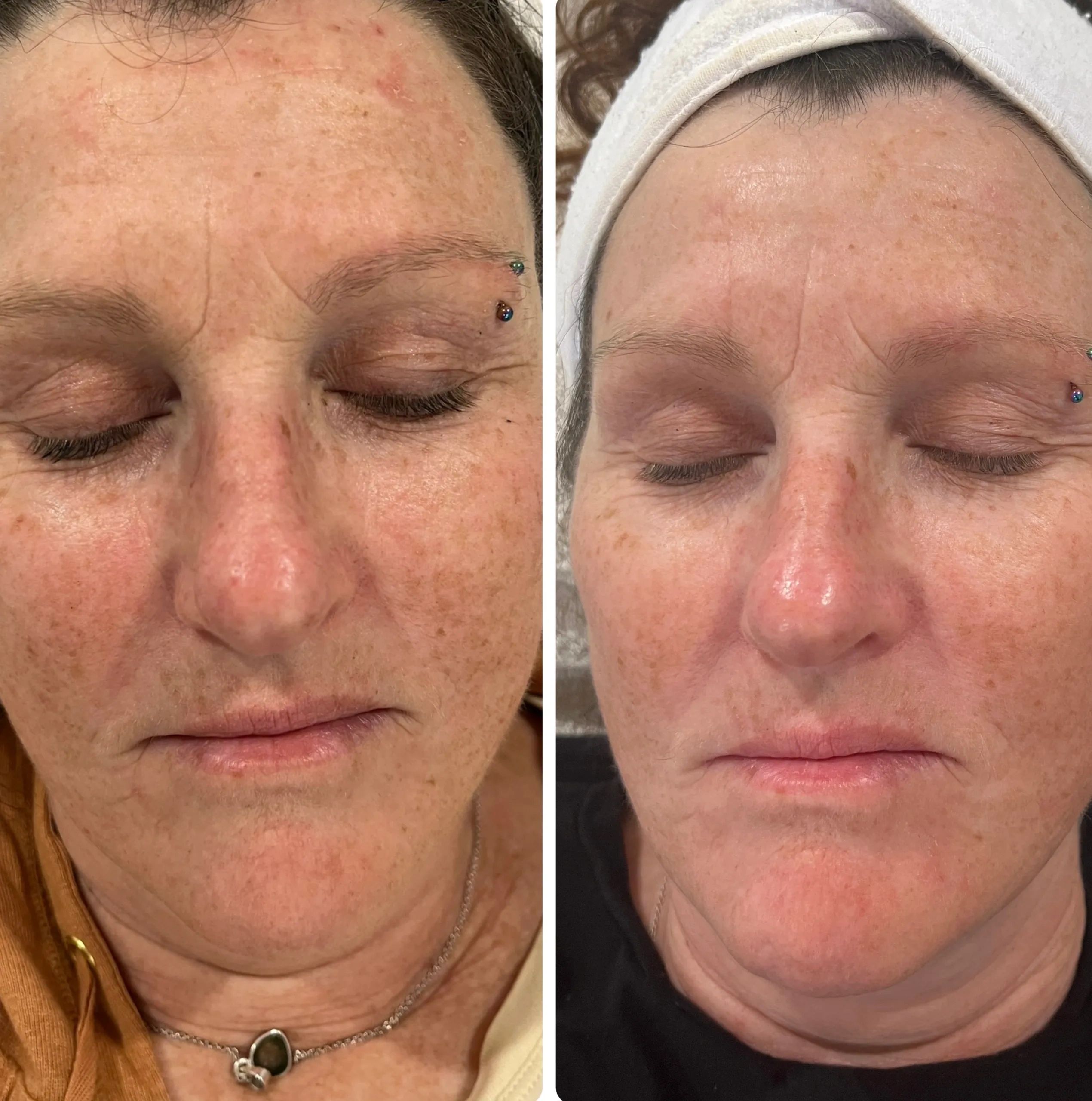 MICRONEEDLING