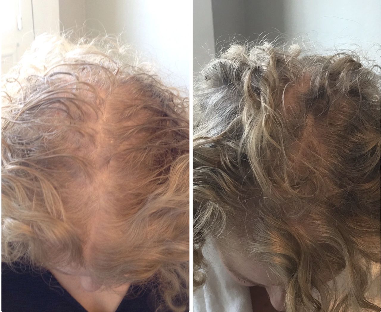 Hair Restoration For Her Refresh Medispa With Dr Tara