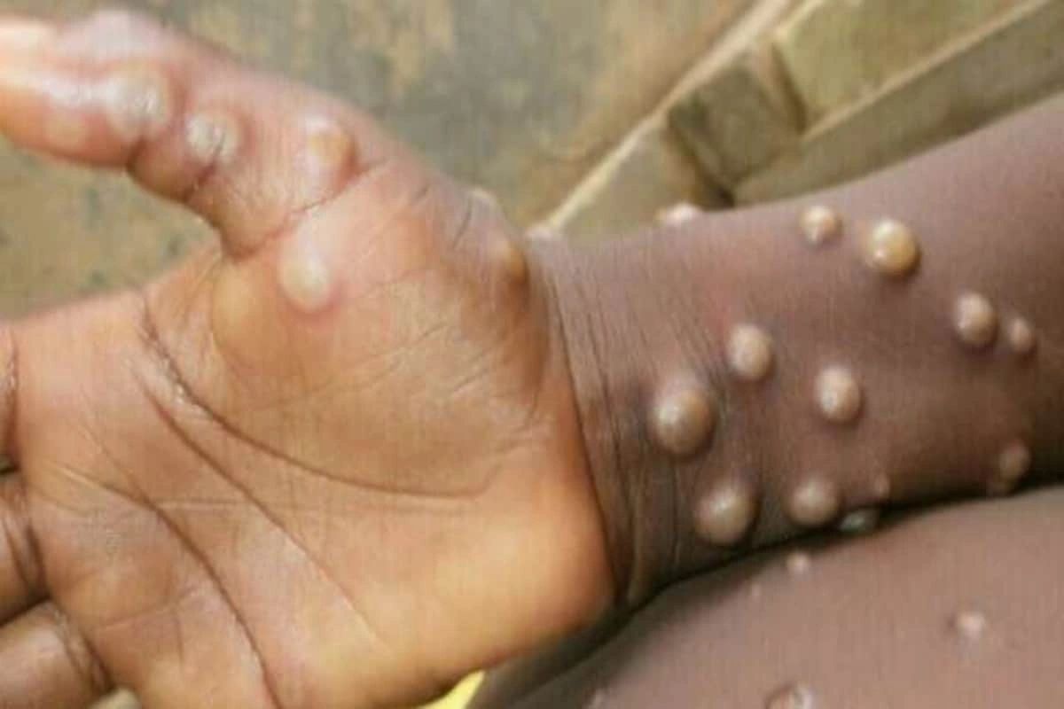 What is monkeypox?