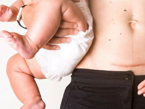 A mother holds her baby, showing a cesarean section scar on her belly.