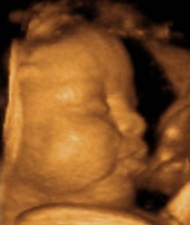 A 4D ultrasound scan of a baby