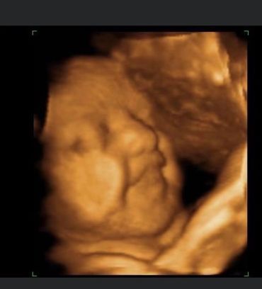 A 4D ultrasound