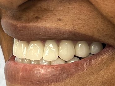 Close-up of a smiling mouth with white teeth and textured lips.