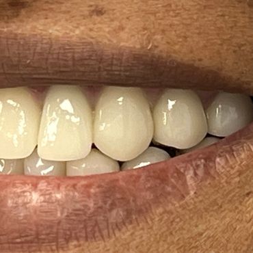 Close-up of a smiling mouth with white teeth and textured lips.