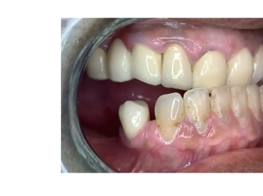 Before: Bite was unaligned, patient had an underbite. 