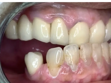 Before: Bite was unaligned, patient had an underbite. 