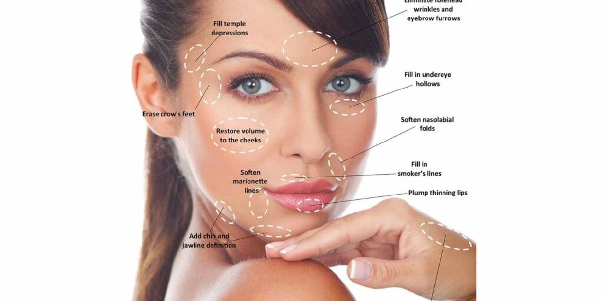 So many areas can be treated with dermal fillers. 