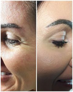 botox beccles, crows feet, botox results, how does botox work
