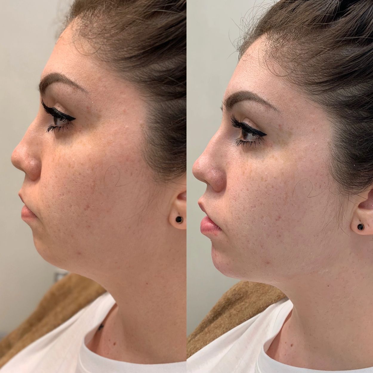 Chin balancing. Chin dermal filler.