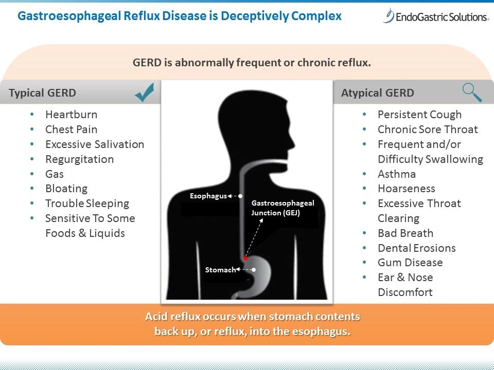 Acid Reflux Evaluation
