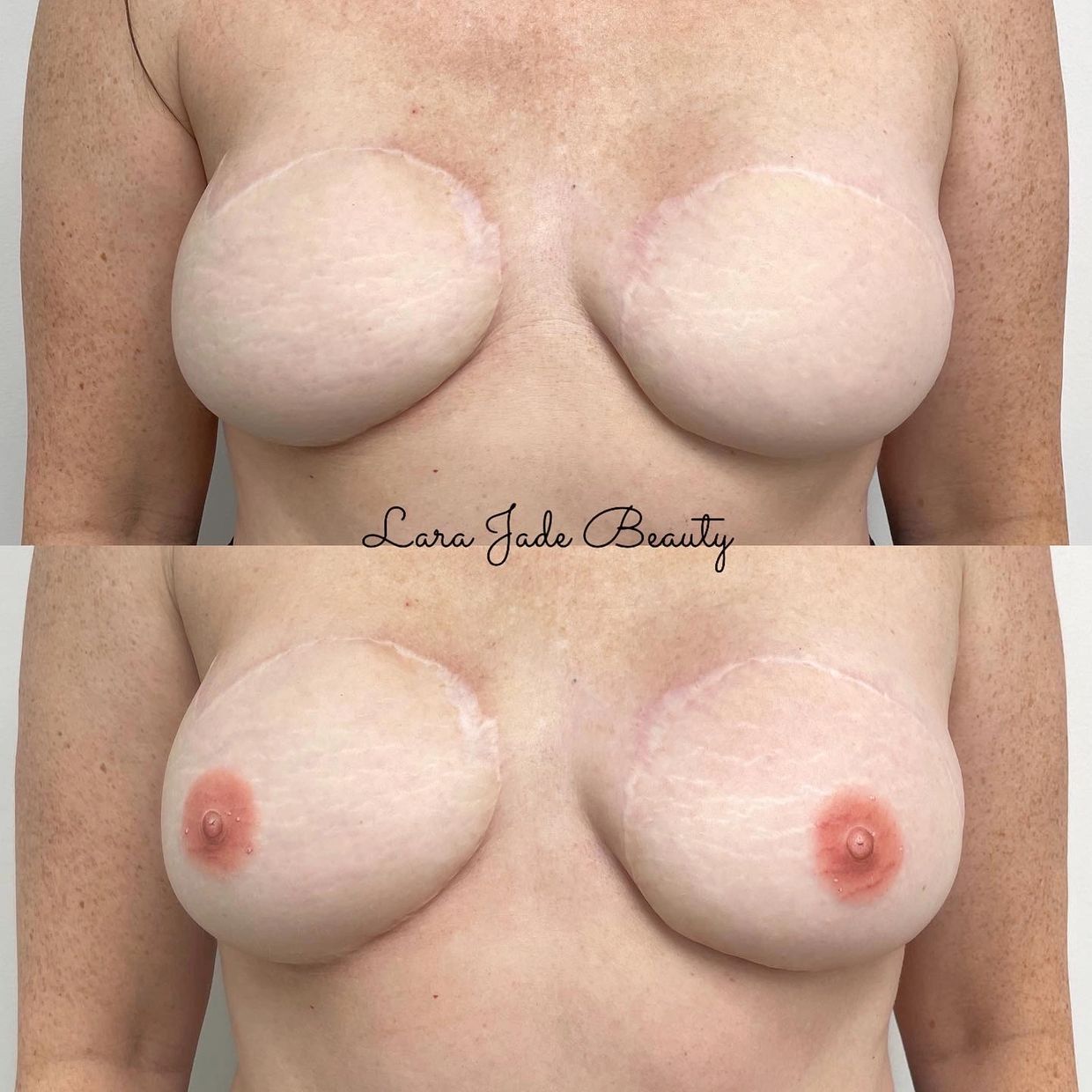 Areola Tattoo Toronto | 3D Nipple Tattooing